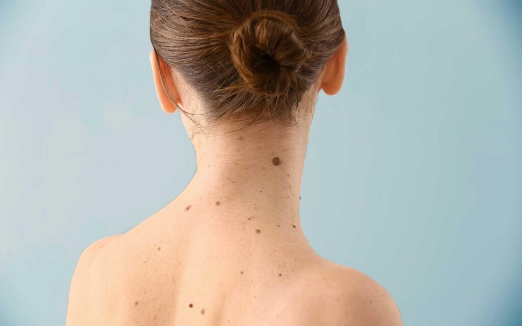Skin tags remedy