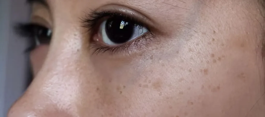 Tiny_black_dots_on_face__Causes_treatment_and_prevention